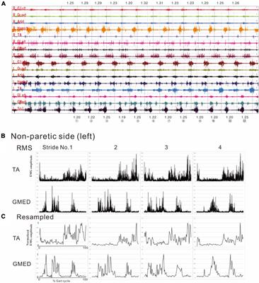 Analysis of muscle synergy and gait kinematics during regain of gait function through rehabilitation in a monoplegic patient